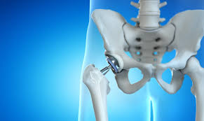 جراحی مفصل لگن و ران - کادر درمان طب لاین - فیزیوتراپی عمل جراحی