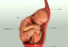 جنین افزایش مایع آمینیوتیک رحم-علل پلی هیدرامینوس-درمان پلی‌هیدرآمنیوس،علائم درمان پلی‌هیدرآمنیوس