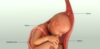 جنین افزایش مایع آمینیوتیک رحم-علل پلی هیدرامینوس-درمان پلی‌هیدرآمنیوس،علائم درمان پلی‌هیدرآمنیوس- آمینوسنتز