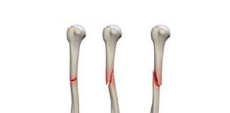 انواع شکستگی-شکستگی سطح مفصلی - شکستگی های گرین استیک - شکستگی های مویی