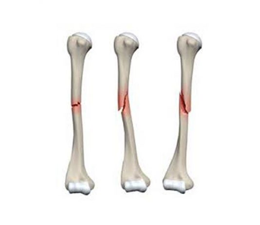 انواع شکستگی-شکستگی سطح مفصلی - شکستگی های گرین استیک - شکستگی های مویی