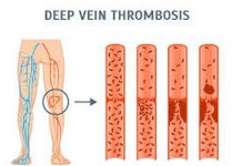 ترومبوز وریدعمقیDVT-درمان ترومبوز وریدعمقیDVT