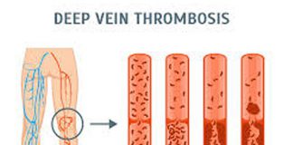 ترومبوز وریدعمقیDVT-درمان ترومبوز وریدعمقیDVT