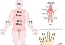 سوختگی درصد - پزشکی - گروه کادر درمان - آسیب به پوست - سوختگی پوست