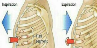شکستگی دنده - نشانه های آسیب قفسه ی سینه-قفسه ی سینه ی شناور-کوفتگی ریه-درمان  شكستگی دنده و جناغ