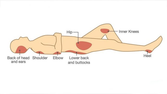 بیماری زخم فشاری - انوع زخم بستر-عوامل ایجاد کننده زخم بستر-تکنیک‌های تغییر وضعیت بیمار-معیار نورتون- جراحت موضعی پوست