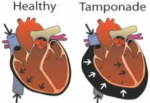 تامپوناد قلبی-مایع جمع شده در فضای جنب-علایم بالینی- تشخیص تامپوناد-تدابیر پرستاری برای تست های تشخیصی تامپوناد