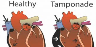 تامپوناد قلبی-مایع جمع شده در فضای جنب-علایم بالینی- تشخیص تامپوناد-تدابیر پرستاری برای تست های تشخیصی تامپوناد