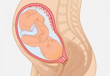 پزشکی قرص - مقایسه تاثیر میزوپروستول و دینوپروستون در زایمان حاملگی