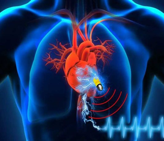 پیس میکریا ضربان ساز قلب | اندیکاسیون پیس میکر و دیس ریتمی | اطلاعات پزشکی طب لاین