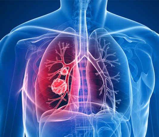 پنوموتوراکس - ادم ریه-دیسترس تنفسی-پرده جنب -علائم و درمان بیماری ریوی