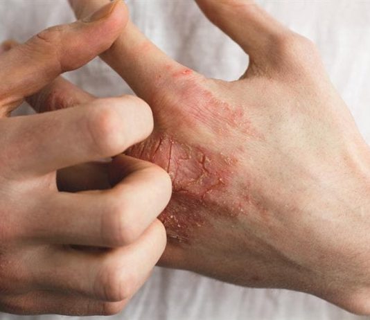 اگزما-پوست-التهاب پوستی-درماتیت
