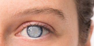 کاتاراکت cataract (آب مروارید چشم) - علائم کاتاراکت-مشکلات پرده شبکیه و عصب بینایی -لنز چشمی-افزایش فشار داخل چشم-پارگی شبکیه
