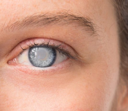 کاتاراکت cataract (آب مروارید چشم) - علائم کاتاراکت-مشکلات پرده شبکیه و عصب بینایی -لنز چشمی-افزایش فشار داخل چشم-پارگی شبکیه