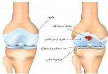 بیماری آرتروز - پزشکی