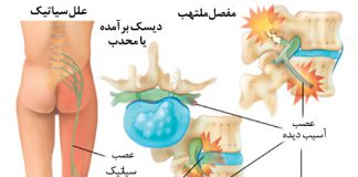سیاتیک - تنگی نخاعی کمری-درمان-عصب-بیماری اعصاب