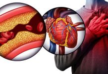 علائم گرفتگی رگ قلب - پزشکی - سکته قلبی