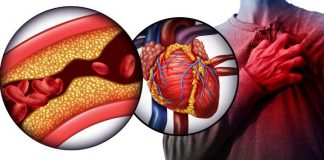 علائم گرفتگی رگ قلب - پزشکی - سکته قلبی