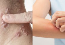 بیماری عفونت پوستی - پزشکی - طب سنتی - بافت نرم پوستی