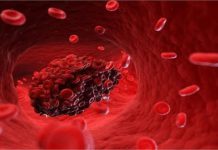 اختلال لخته شدن خون - پزشکی - رگهای بدن - سیستم گردش خون