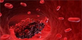 اختلال لخته شدن خون -عروق خونی-لخته شدن خون-آمبولی-ترومبوز سیاهرگی عمقی- سیستم گردش خون