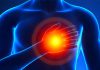 آنژین یا حملات قلبی - احساس فشار در قفسه سینه - آنژین یا حملات قلبی