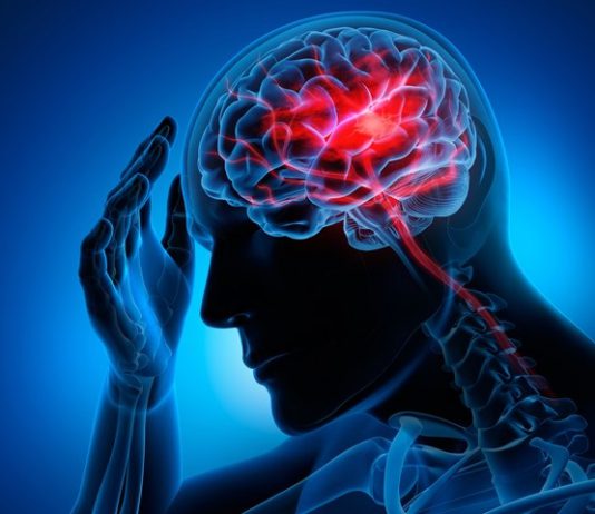 فیزیوتراپی سکته مغزی - متخصصین علوم پزشکی - آسیب‌های عروقی مغز