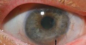 علائم التهاب قرنیه - عوارض لنزهای چشمی-کوری