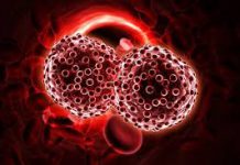علائم سرطان خون -شیمی درمانی-لنفوسیت ها - سلول های خونی