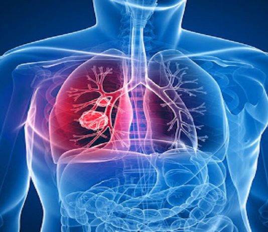 عفونت دستگاه تنفسی -برونشیت-درمان و علائم - گروه کادر درمان پرستاری و پزشکی طب لاین