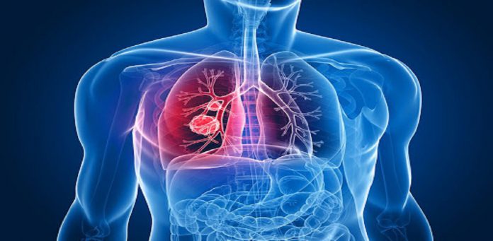 عفونت دستگاه تنفسی -برونشیت-درمان و علائم - گروه کادر درمان پرستاری و پزشکی طب لاین