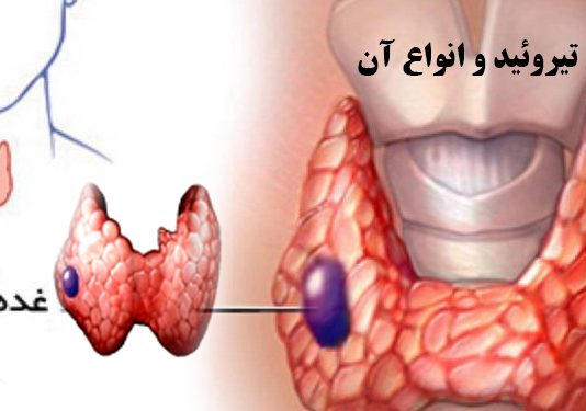 غده تیروئید - علوم پزشکی طب لاین - هیپوتیروئیدیسم