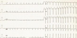 تفسیر نوار قلب-ECG- ریتم های غیر طبیعی قلب، گرفتگی رگهای کرونر ،سکته‌های قلبی، هایپرتروفی، عضلات قلب ،علل تنگی نفس ،اختلالات الکترولیتی