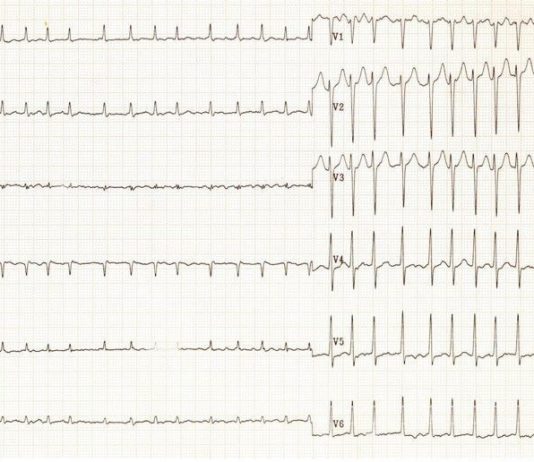 تفسیر نوار قلب-ECG- ریتم های غیر طبیعی قلب، گرفتگی رگهای کرونر ،سکته‌های قلبی، هایپرتروفی، عضلات قلب ،علل تنگی نفس ،اختلالات الکترولیتی