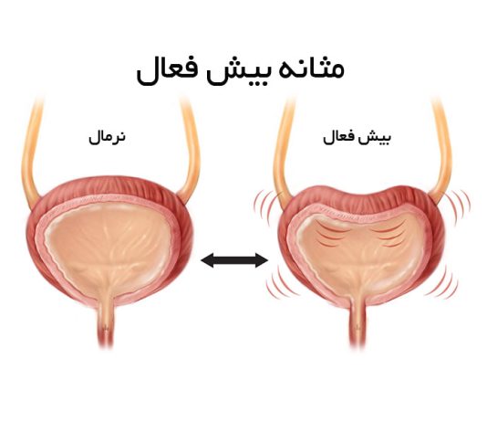 سندرم مثانه بیش فعال-اورولوژی-کلیه و مجاری ادراری-تکرر ادرار-سنگ مثانه-پروستات