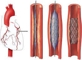 آنژیوپلاستی قلب-استنت قلبی